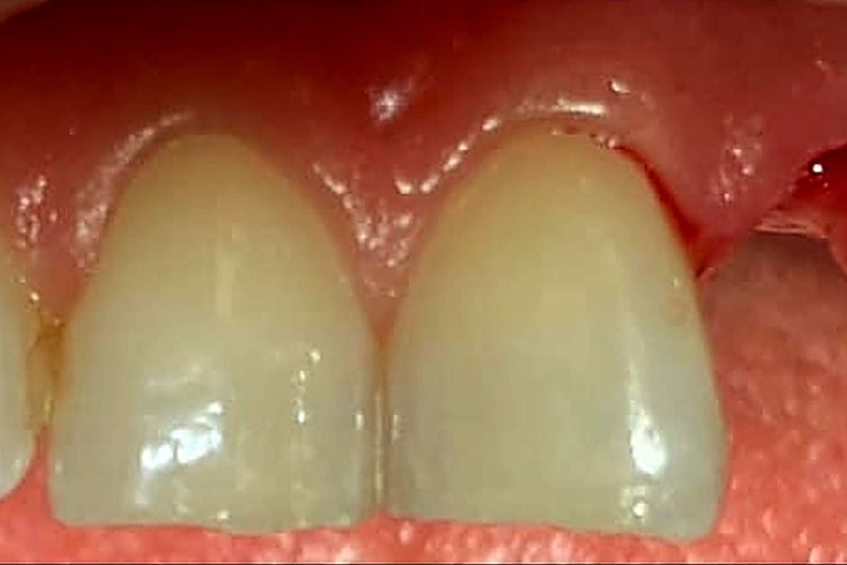 Foghiány pótlása implantációval – előtte