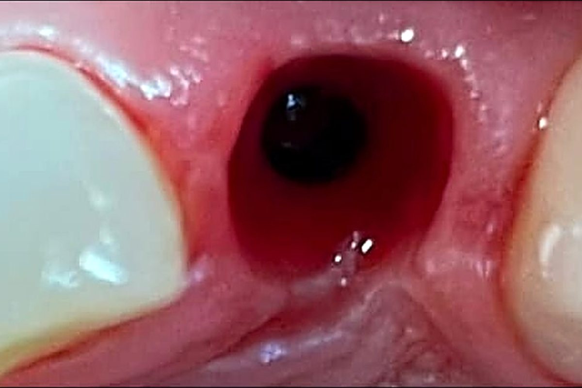 Foghiány pótlása implantációval – közben