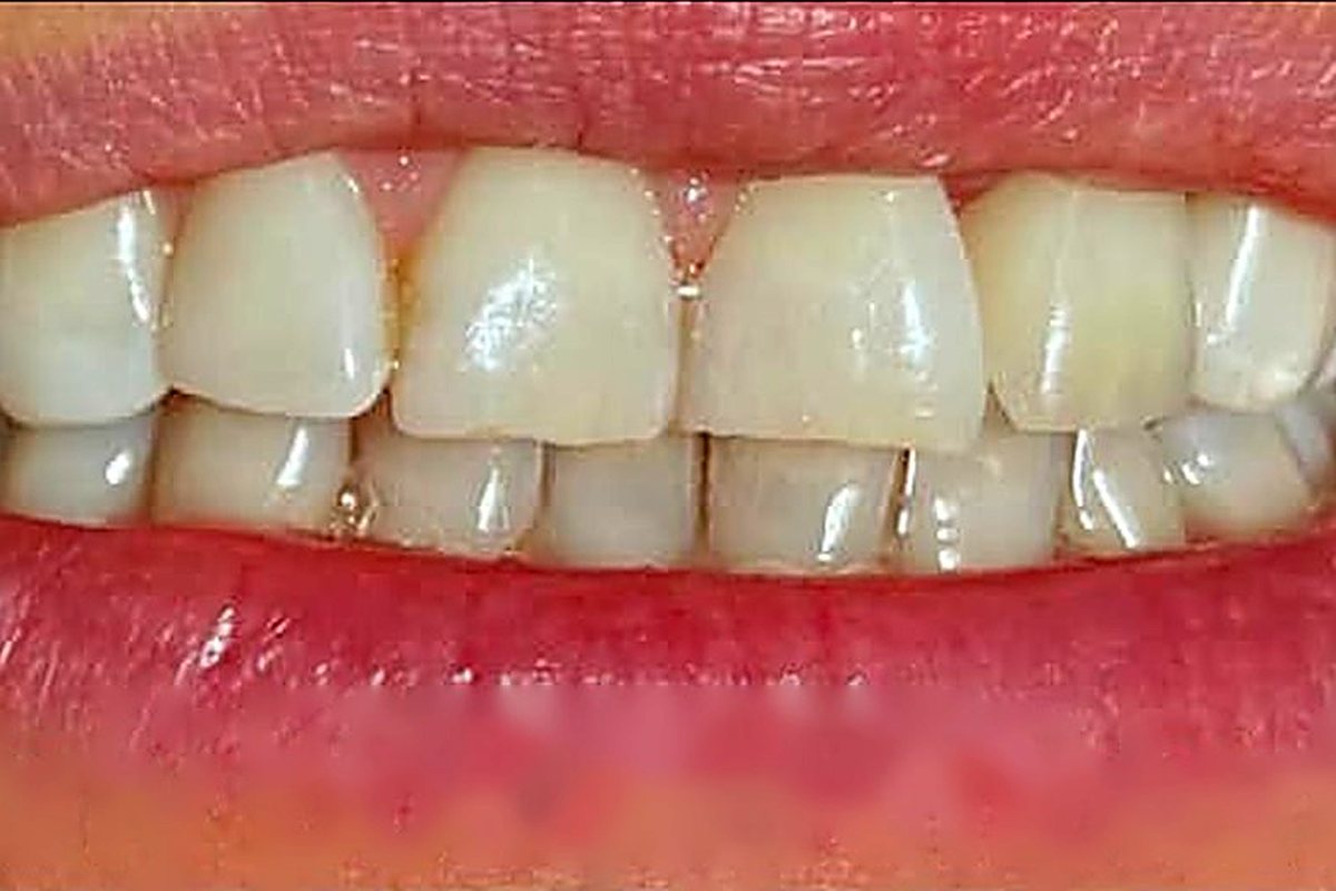 Foghiány pótlása implantációval – utána